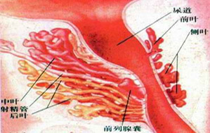 前列腺囊肿